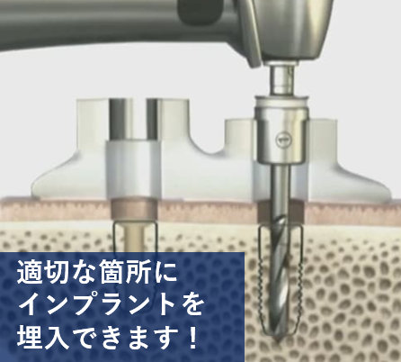 より安全性を高めるための「サージカルガイド」