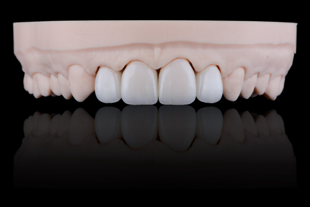 詰め物・被せ物の調整